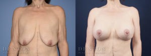 Breast Lift w/ Implants B&A 1A