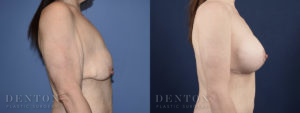 Breast Lift with Implants Patient 1-C: Before and After