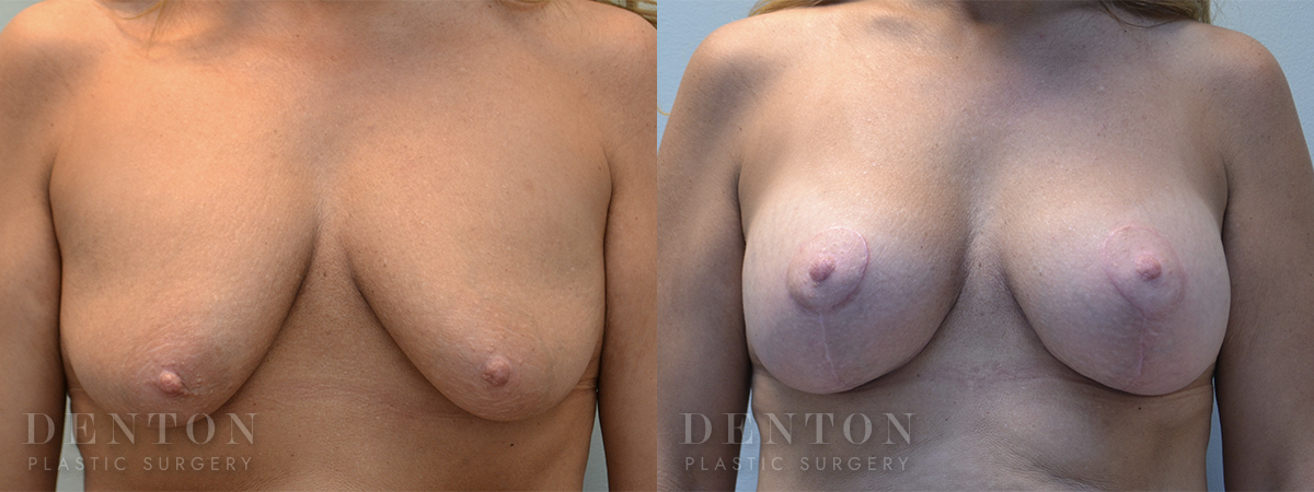 Breast Lift w/ Implants B&A 2A