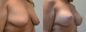 Breast Lift w/ Implants B&A 2B