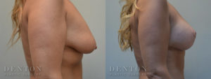 Breast Lift w/ Implants B&A 2C