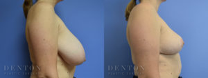 Breast Lift Patient 1-C: Before & After