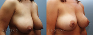 Breast Reduction B&A 2B