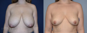 Breast Reduction B&A 3A