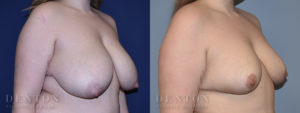 Breast Reduction B&A 3B