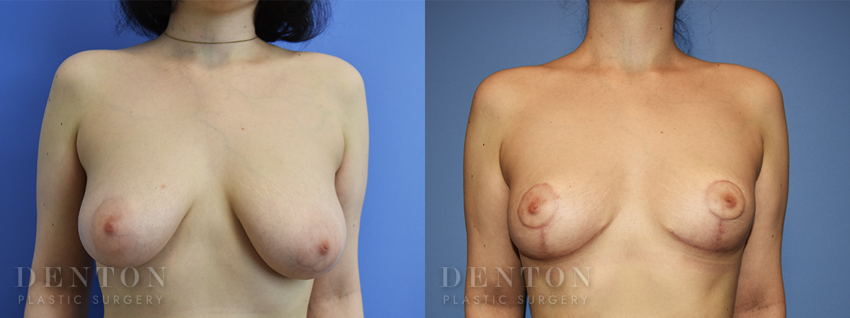 Breast Reduction B&A 4A