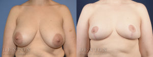 Breast Reduction B&A 5A