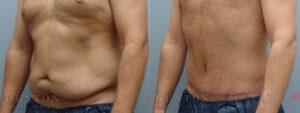 Tummy Tuck Patient 1-A: Before & After