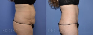 Tummy Tuck Patient 3-A: Before & After